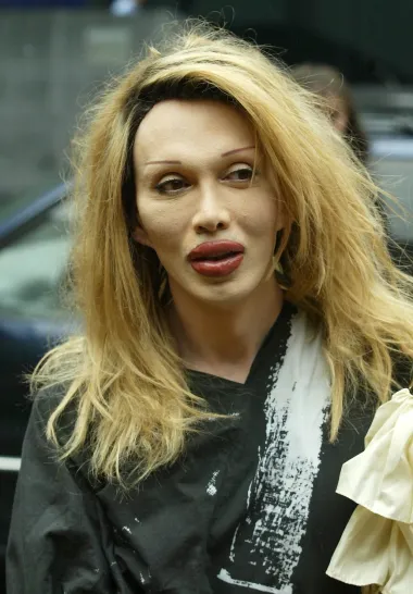 Pete Burns je pokojni britanski pjevač, tekstopisac i televizijska ličnost, a pri kraju svog života nije pažnju javnosti plijenio glazbenim uspjesima već svojim zastrašujućim izgledom. Naime, Burns je bio teški ovisnik o estetskoj kirurgiji, a tijekom života je nekoliko puta povećavao usne, smanjivao nos i operirao jagodične kosti na licu. Osim toga, zatezao je kožu te obožavao androgini izgled, pa je često posezao za operacijama koje su naglašavale njegovu žensku stranu. Iznos kojim je platio sve te operacija vrti se oko desetak tisuća dolara, što je u usporedbi s nekim drugim imenima na ovoj listi, još i jako skromna cifra. 