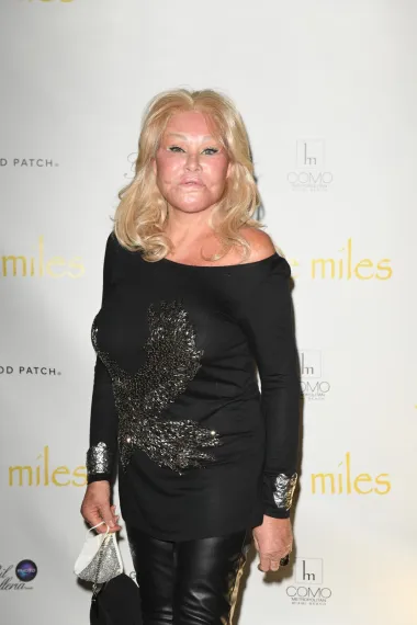 Jocelyn Wildenstein vjerojatno je najpoznatija žrtva plastičnih operacija na svijetu. Ovu ovisnicu o estetskoj kirurgiji nazivaju i &quot;Ženom-mačkom&quot; i to zbog njezinih iskrivljenih proporcija lica i očiju. Navodno je opsesija ove dame da se operira krenula zbog toga što je željela udovoljiti svom suprugu koji je jako volio mačke. Odlučila se tako i sama, uz pomoć plastičara, pretvoriti u jednu, a danas izgleda apsolutno neprepoznatljivo. Ipak, nekoliko je puta izjavila kako nikada ne planira stati s operacijama te da se želi operirati na redovitoj bazi sve do smrti. Sve skupa, procjenjuje se da je za svoje umjetno lice dala više od 6 i pol milijuna dolara.