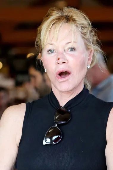 Melanie Griffith danas ima 64 godine, a iako je nekoć bila seks simbol i zanosna plavuša Hollywooda, danas se poprilično promijenila te svojim izgledom većinom užasava. Naime, Melanie je nekoć bila tiha patnja muškaraca diljem svijeta, a poznata je i po svojim brakovima s Don Johnsonom i Antoniom Banderasom. Uspjela je tako zavesti i mnoge slavne i zgodne frajere, no s ulaskom u 40-e se počela relativno redovito operirati i puniti botoksom. Operirala je nos, usta nekoliko puta, a zetazala je i lice i kožu na vratu, a na kraju ju je opsesija odlascima pod nož plastičara koštala prirodnog izgleda. Danas i sama Melanie smatra da je pretjerala, pa definitivno smatramo kako nije dostojanstveno ostarjela. 