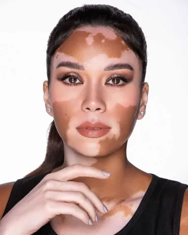 Vitiligo se očituje kada melanociti, stanice odgovorne za pigmentaciju kože, odumru ili postanu nestabilne za funkcioniranje. 