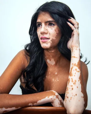Liječnici i znanstvenici smatraju da se vitiligo javlja kao posljedica postojanja poremećaja imunološkog sustava, odnosno da je vitiligo autoimuni poremećaj.