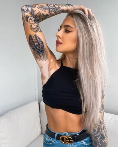 Vitiligo je često udružen s nekim autoimunim bolestima - najčešće s bolestima štitnjače, šećernom bolesti, pernicioznom anemijom i alopecijom.