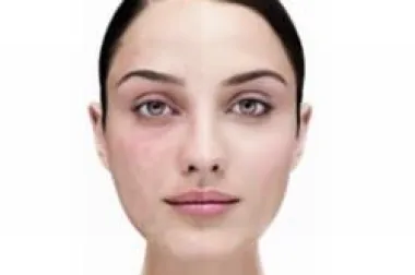 DERMABLEND&trade; - za višu kvalitetu života ljudi s kožnim nepravilnostima