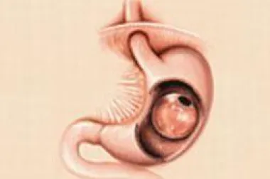 Intragastrični balon – endoskopska metoda za liječenje debljine