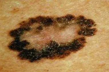 EUROMELANOMA DAY: Gledajte svoje madeže redovito; otkrijte melanom što ranije!