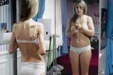 Anorexia nervosa – uzroci, simptomi i načini liječenja