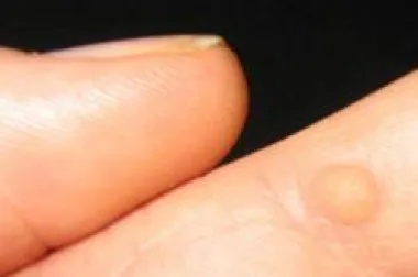 Život s bradavicama je život s HPV-om