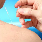 Akupunktura i homeopatija u prevenciji i liječenju gripe