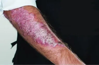 Život s psorijazom