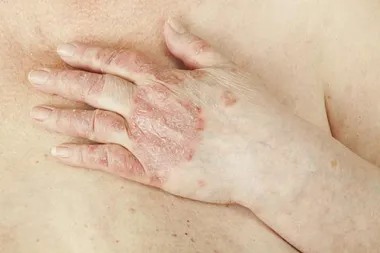 Psorijaza - prokletstvo pod kontrolom