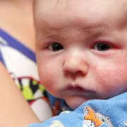 Atopijski dermatitis – liječenje prema najnovijim smjernicama