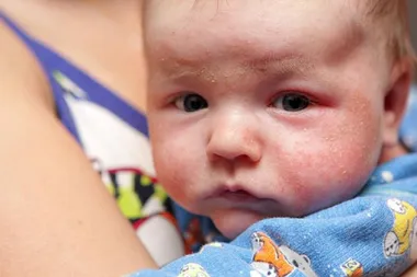Atopijski dermatitis – liječenje prema najnovijim smjernicama