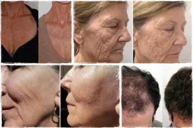 Vampirski Facelift – PRP