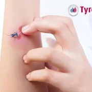 Što raditi s raščešanim ranama nakon uboda komaraca?