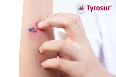 Što raditi s raščešanim ranama nakon uboda komaraca?