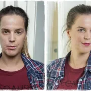 Pitanje za dermatologa: korištenje pudera na koži sklonoj aknama, dozvoljeno ili ne?