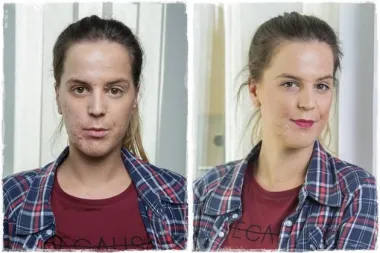 Pitanje za dermatologa: korištenje pudera na koži sklonoj aknama, dozvoljeno ili ne?