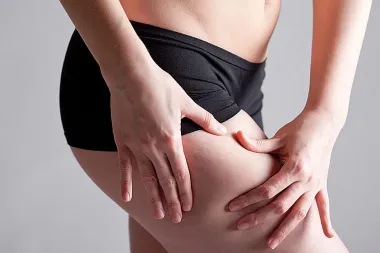 Celulit – kako ga se konačno riješiti?