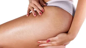 6 savjeta koji će pomoći da ti strije postanu neprimjetne