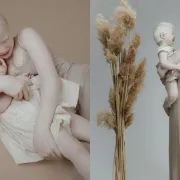 Albino sestre osvojile društvene mreže svojim fotografijama