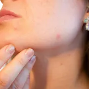 Stres, kontracepcijske pilule i menstrualni ciklus najčešći su krivci za pojavu hormonalnih akni