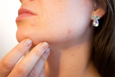 Stres, kontracepcijske pilule i menstrualni ciklus najčešći su krivci za pojavu hormonalnih akni