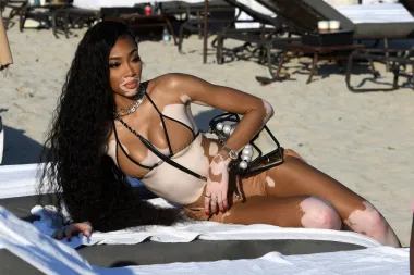 Fizičke mane pretvorila je u prednosti: Winnie Harlow najneobičniji je model današnjice