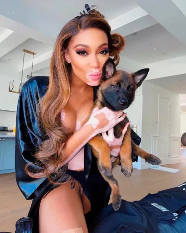 Fizičke mane pretvorila je u prednosti: Winnie Harlow najneobičniji je model današnjice