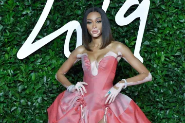 Fizičke mane pretvorila je u prednosti: Winnie Harlow najneobičniji je model današnjice