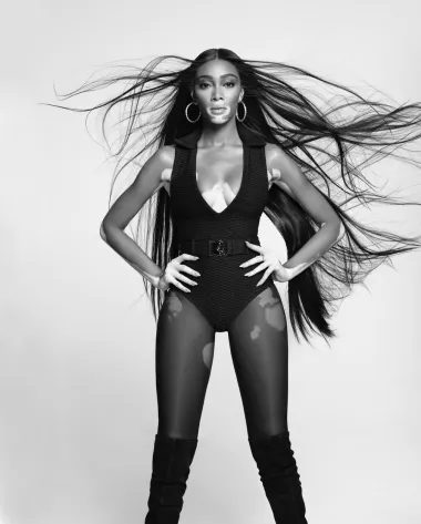 Fizičke mane pretvorila je u prednosti: Winnie Harlow najneobičniji je model današnjice