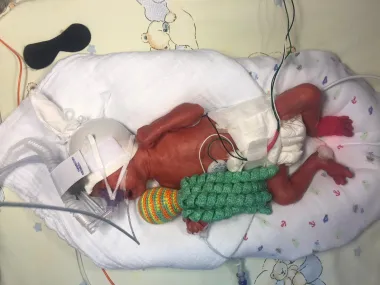 Klara je rođena u 28. tjednu sa samo 1080 grama i pokazala je što je hrabrost