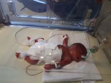 Kako su se, unatoč lošim prognozama, Palčići Fran, Kajo i Dominik izborili za život
