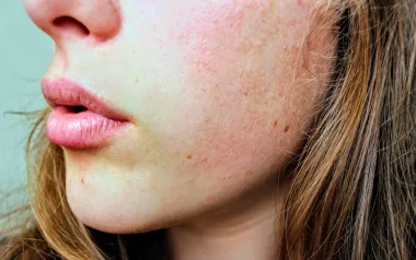 Atopijski dermatitis: Sve što trebaš znati o ovoj kožnoj bolesti