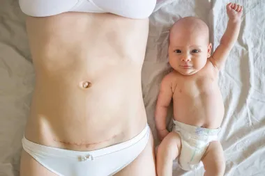 Strah i sreća: Dirljive ispovijesti 5 mama koje su rodile carskim rezom