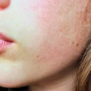 Dr. Kolić o atopijskom dermatitisu kod odraslih