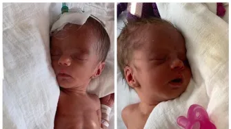 Blizanke Tena i Lena zajedno su imale 3,5 kg kad su se rodile -  danas su zdrave četverogodišnjakinje