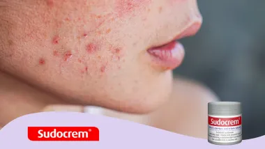 Sudocrem® kao najbolje čuvana beauty tajna