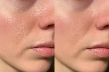 Kako smanjiti proširene pore na licu? Evo što učiniti za ujednačenu kožu