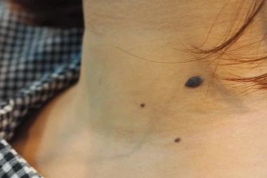 Dermatologinja o čestoj promjeni kože: Evo za&scaron;to se ne smije vjerovati internetu