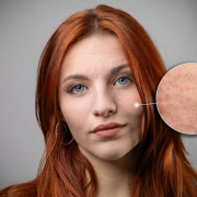 Dermatologinja o čestoj promjeni kože: Evo za&scaron;to se ne smije vjerovati internetu