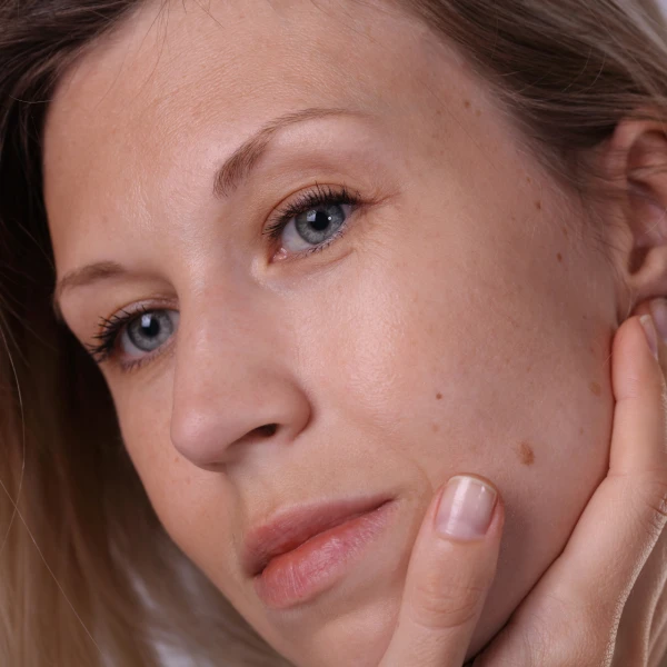 Dermatologinja o čestoj promjeni kože: Evo za&scaron;to se ne smije vjerovati internetu